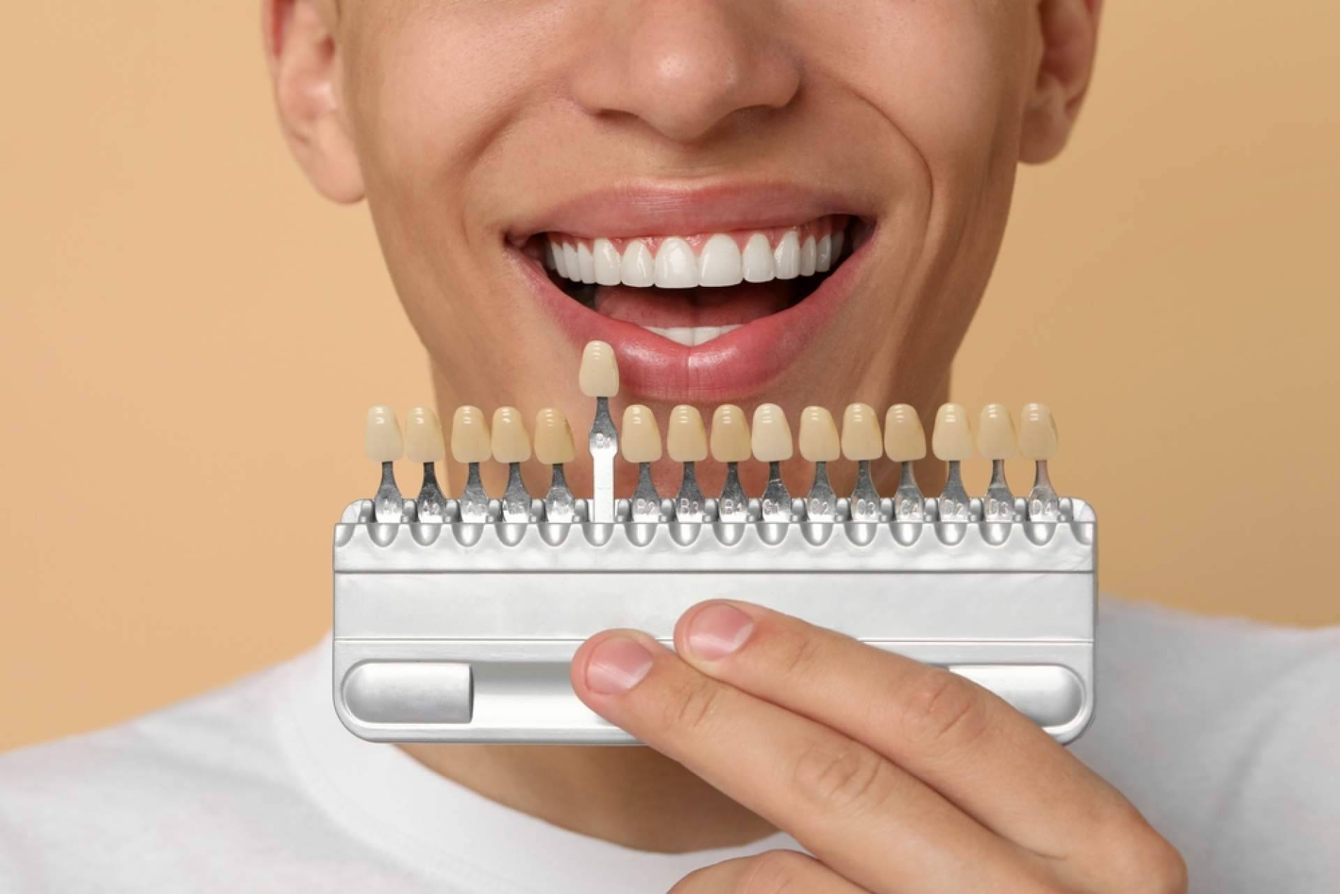 Carillas dentales estéticas, accesibilidad y diseño a medida con Cobertura Dental